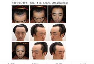 网友曝华晨宇植发整容照，称张碧晨当小三