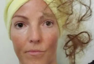 加拿大女子被新冠后遗症折磨9个月 头发全毁了