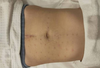 女子花15.8万做胸部填充术却生疙瘩 一抬手就疼