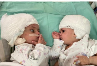 以色列连体婴分离手术成功后 终于首次看到彼此