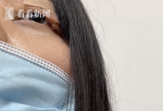 最倒霉的医美：做双眼皮6年 还不能闭眼睡觉