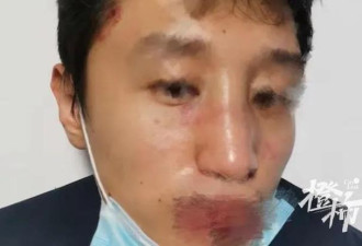 中国留学生被暴打至骨折,原因让人很愤怒