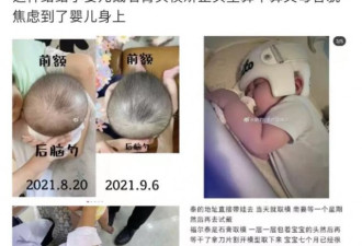 给婴儿戴头盔矫正头型，容貌焦虑已成这样了？