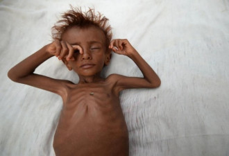 也门遭遇严重饥荒 全国一半人吃不饱饭