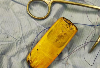 男子腹痛难忍 医生在其肠中发现一部完整手机