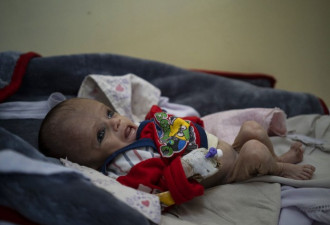 阿富汗粮食不足 喀布尔医院2个月25儿童死亡