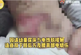 1岁男童睡电热毯 尿床惨被烧成二度重伤