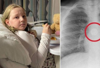 英国9岁女孩不小心吞下电池食道烧伤