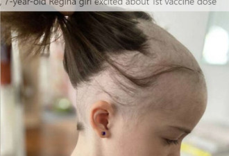 惨不忍睹：7岁女孩感染病毒后头发掉成这样