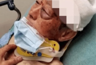 81岁亚裔被殴打左眼刺穿:你是中国人或越南人?