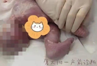 女子怀孕5个月 发现胎儿竟有“尾巴”？
