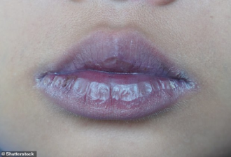 嘴唇发灰或是新冠：专家公布多条新症状