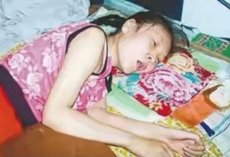 5岁懒惰女装瘫痪 竟一躺就是20年