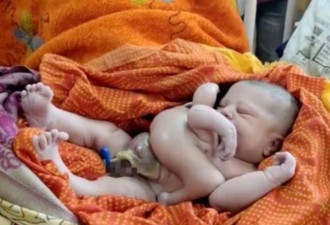 孕妇诞下8肢婴儿 拥4手4腿 村民冲医院朝圣