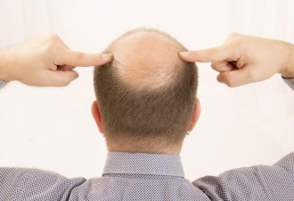 秃顶青年有救了 基因改造毛发干细胞