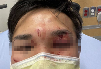 多伦多大学中国留学生遭殴打：双眼缠纱布
