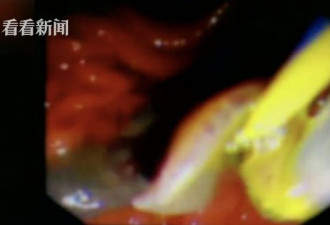她腹痛送医 竟是肝脏被巨虫吃掉1/3 只因爱吃这