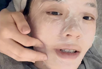 林允晒打美容针视频 额头渗出血珠