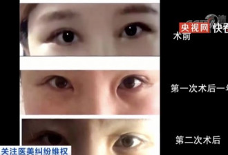 女子8万整容整成9级伤残:眼睛很痛