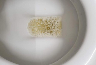 为什么有的尿液中有很多泡沫？是尿毒症吗？