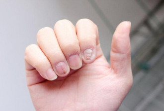 指甲上的月牙越多，越健康吗？注意这5种变化