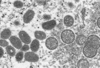 加拿大惊现13例疑似猴痘病毒