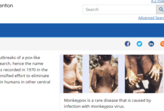 天花“亲戚”猴痘病例今年首次在美出现