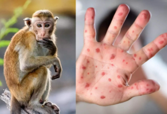 猴痘疫情爆发两种人群高危 恐成永久地方流行病