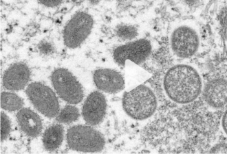 警惕：猴痘蔓延美国7个州 潜伏期7至14天