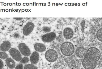 多伦多新增确诊3例猴痘