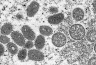 6月4日头条:多伦多华裔女孩溺亡 猴痘确诊再增