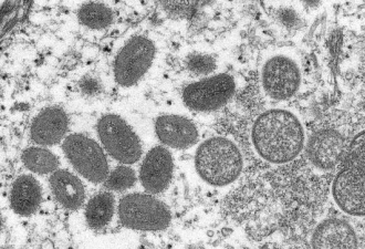 暴增780例 猴痘扩散27个国家 WHO发警告