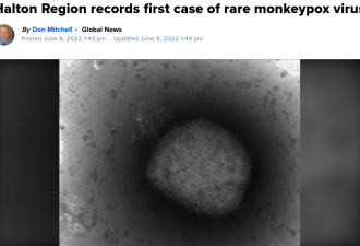 Halton地区发现首例猴痘