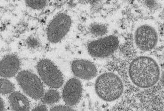 世卫下周举行紧急会议 可能将猴痘列为全球新疫情