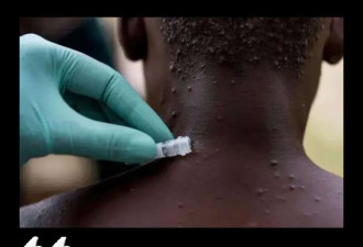 中国惊现首例猴痘:密接19人!危险可能就在不远处