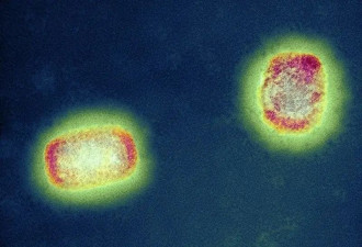 猴痘，会成为下一个超级传染病吗？
