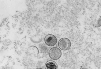 猴痘首次在澳本土传播 皮肤接触可传染