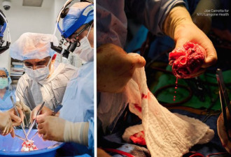 成功完成2例 人移植猪心脏手术距成功又近一步