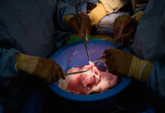 美国完成2例猪心人体移植 25年开始临床