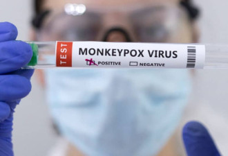 安省288例猴痘76%在多伦多 新增儿童和女性感染者