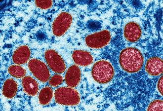 安省猴痘病例一周增15% 已有州区宣布紧急状态