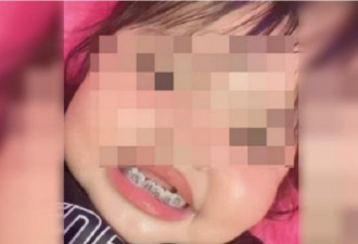 她给3岁女儿戴牙箍矫正乳齿 网轰：有必要吗？
