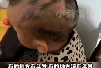 2岁男童怪异脱发一碰就掉，母亲急哭