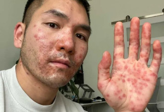 华裔小哥确诊猴痘，出现罕见症状！眼睛长疹渗液，就诊6次查不出