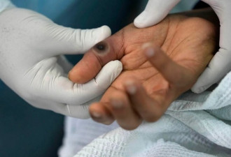 香港传出猴痘首例 30岁男隔离治疗