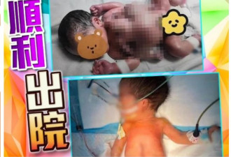 深圳现4手4脚婴儿 属全球罕见寄生胎