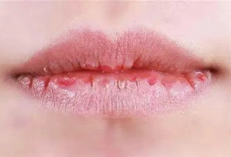 让你远离撕裂的痛——8个天然护唇法