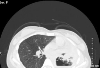 25岁女孩肺被“吃掉”只剩空洞，医生警告