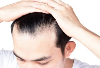 男性脱发 是雄激素分泌过多惹的祸？