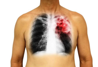 生活中这5个坏习惯 会损伤肺部健康